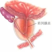 宝鸡前列腺炎医院：尿频尿急尿痛，靠忍就好了