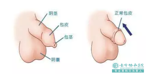 沭阳敖汉旗做包皮手术去哪个医院